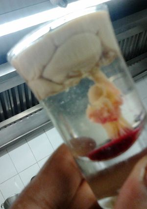 A picture of brain hemorrhage.