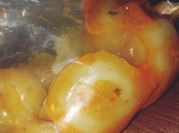 Gambar pentol lemak sapi