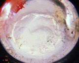 A picture of step 3 of Kadhi muthiya.