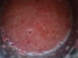 Matar mushroom