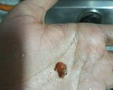 A picture of step 20 of Dhaba Style Lauki/ Gheeye Ke Kofte.